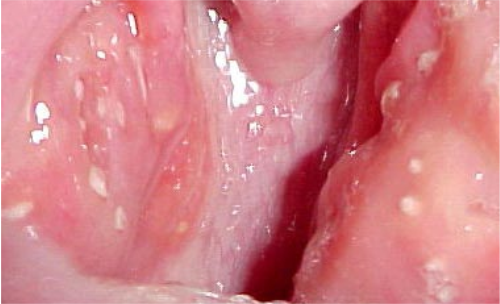 tonsils.png